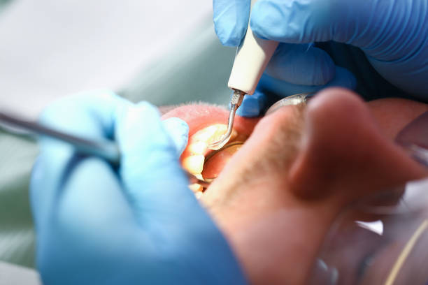 Best Chipped Tooth Repair Near Me  in Ben Avon, PA